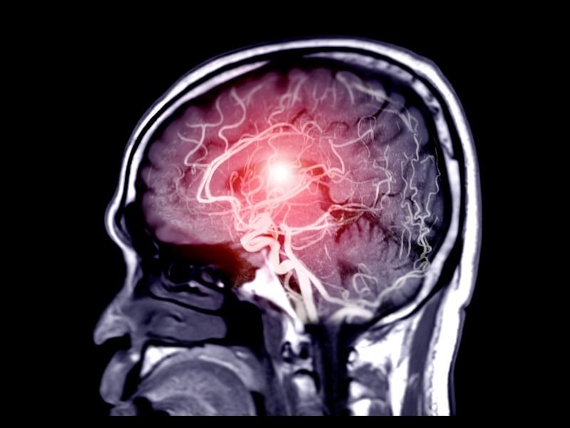 Tratamento da Aneurismas Cerebrais em Sao Paulo