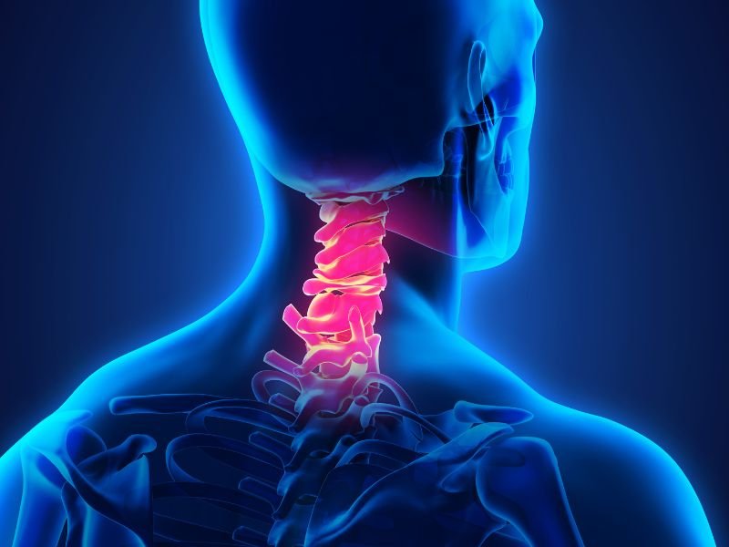 Tratamento da Artrodese Cervical em Sao Paulo