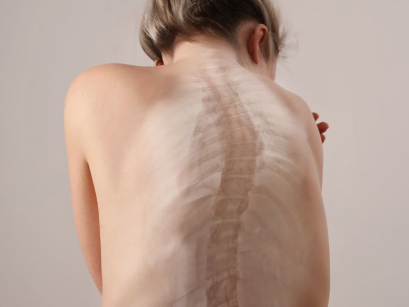 Tratamento da Escoliose Idiopatica em Sao Paulo