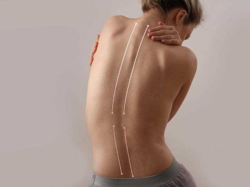 Tratamento da Escoliose em Sao Paulo