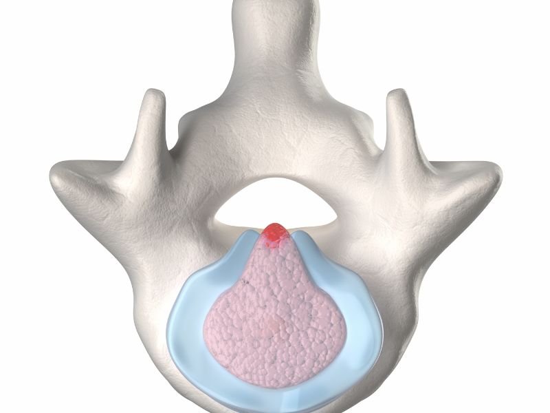Tratamento da Extrusao Discal em Sao Paulo