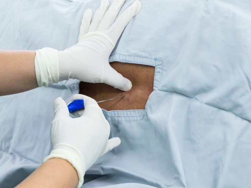 Tratamento da Infiltracao Facetaria em Sao Paulo