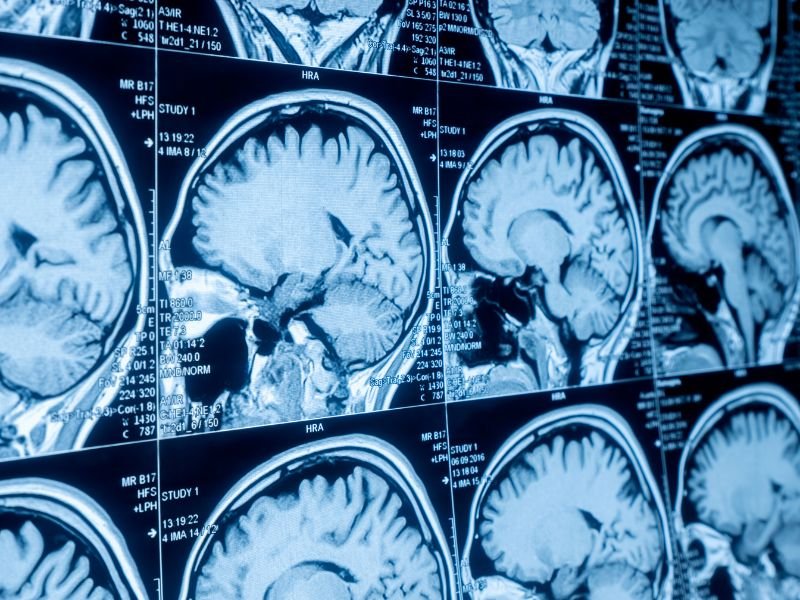 Tratamento da Tumores Cerebrais em Sao Paulo