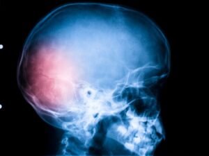 Cirurgia para traumatismo craniano Sao Paulo