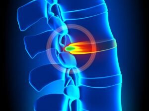 Hernia de disco dor ciatica SP