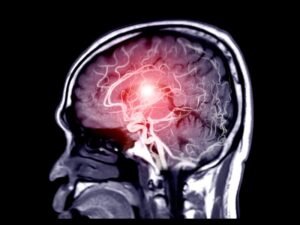 Neurocirurgia para aneurismas cerebrais SP