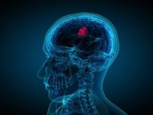Neurocirurgia para tumores cerebrais SP
