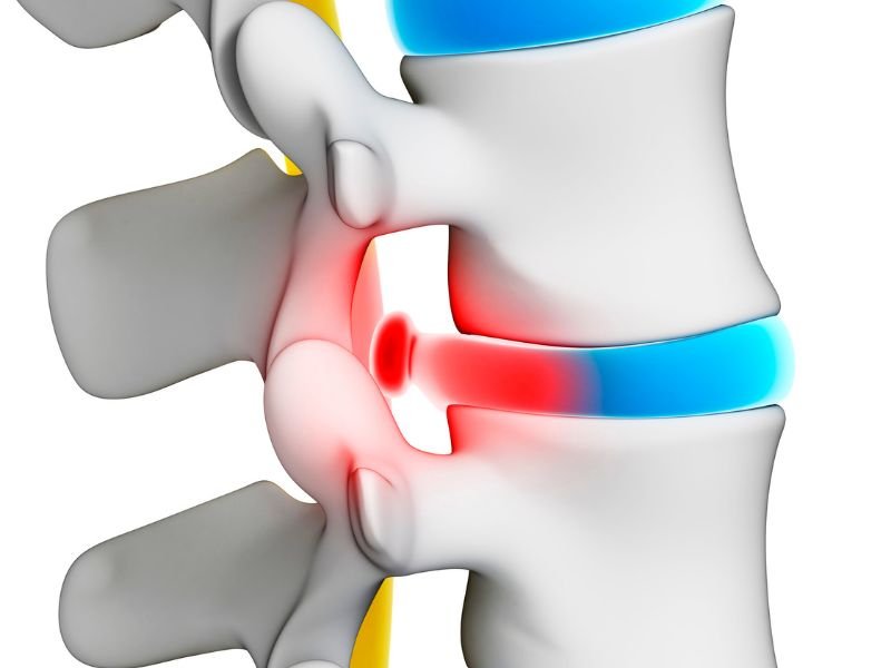 Nucleoplastia hernia de disco Sao Paulo