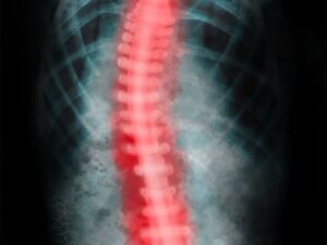 Tratamento para escoliose degenerativa SP